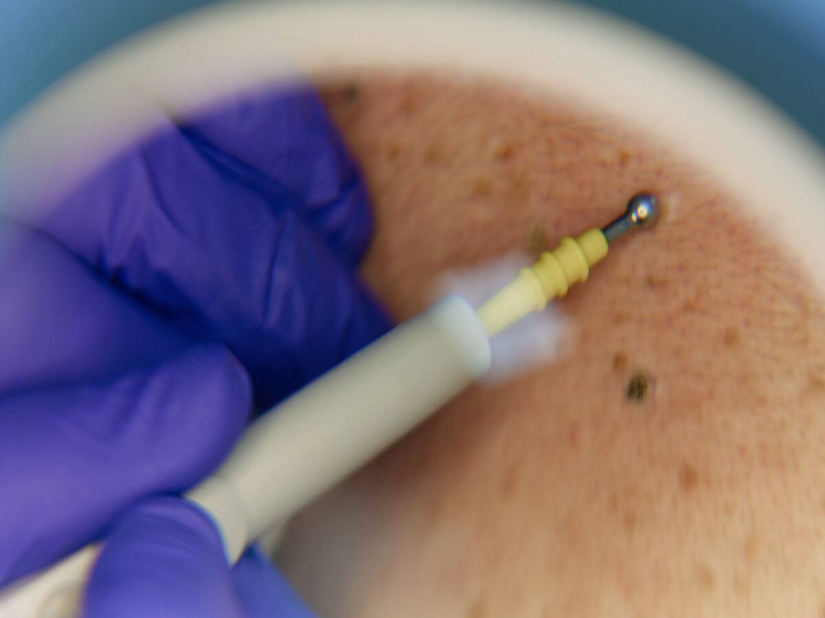 El 100% de las verrugas genitales son manejables: sexólogo