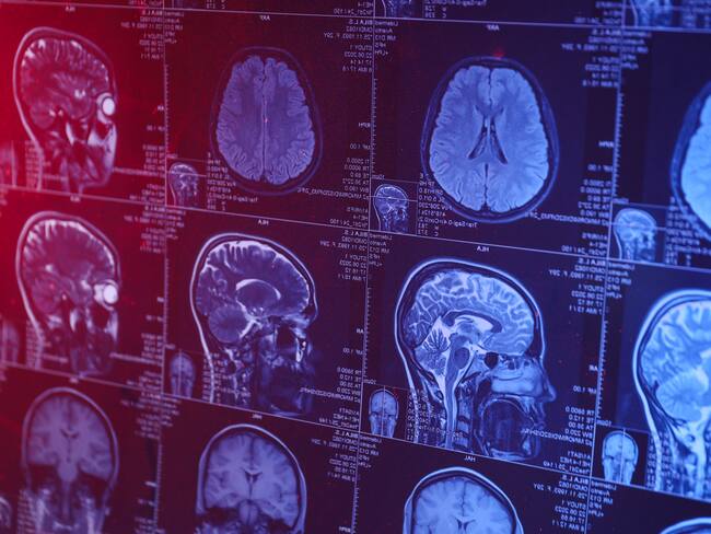 Tumores cerebrales, imagen de referencia. Getty Images