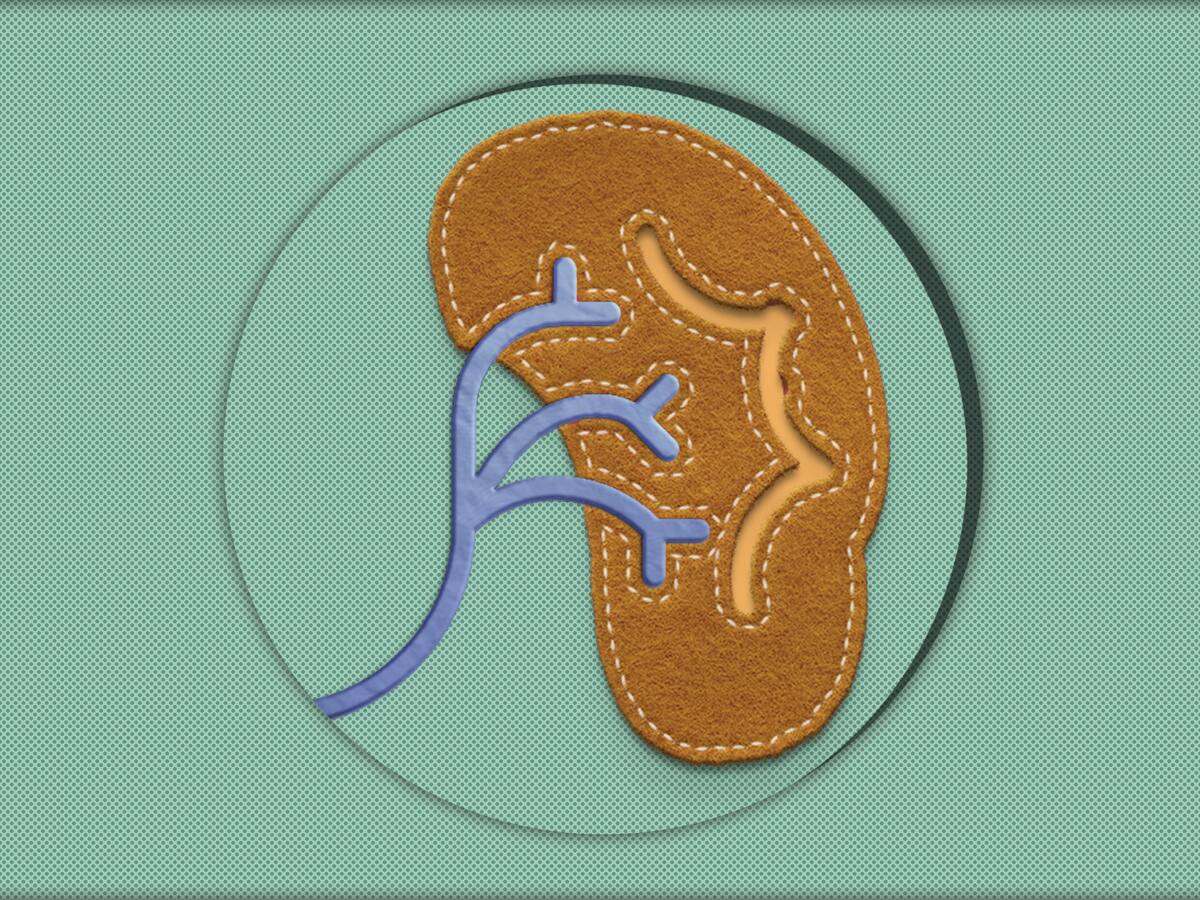 ¿Cómo tratar los cálculos en los riñones? Urólogo explicó