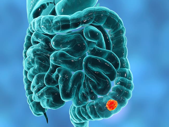 Científicos identifican células causantes de metástasis en el cáncer de colon