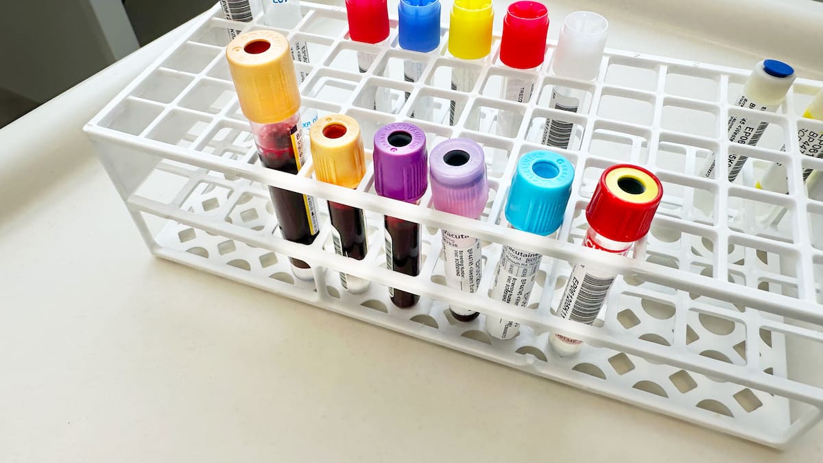 ¿Cómo saber si debe tomar medicamentos para controlar el colesterol? Esto dijo un experto
