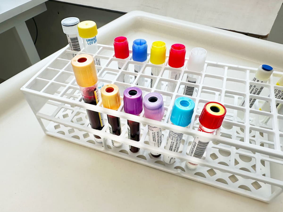 ¿Cómo saber si debe tomar medicamentos para controlar el colesterol? Experto lo explicó