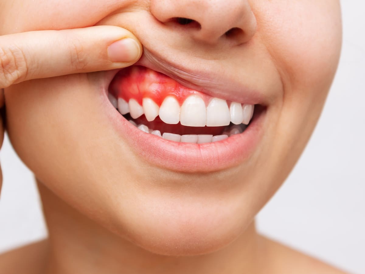 ¿Encías inflamadas? Las posibles causas de este síntoma