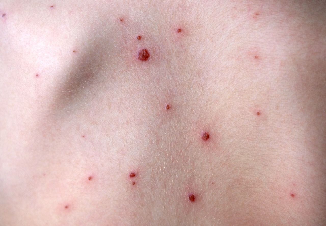 Imagen de referencia de la viruela del mono. Foto: Getty Images.