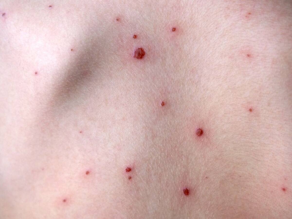 Cali confirma el primer caso de viruela del mono