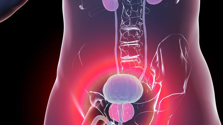 Estos son algunos factores externos que podrían influir para tener cáncer de próstata