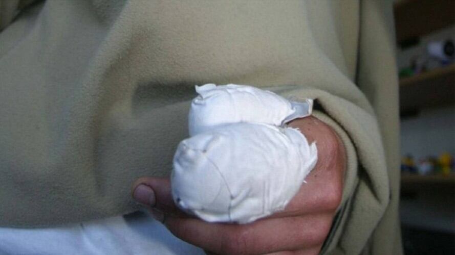 Lesionados con pólvora. Foto: Colprensa