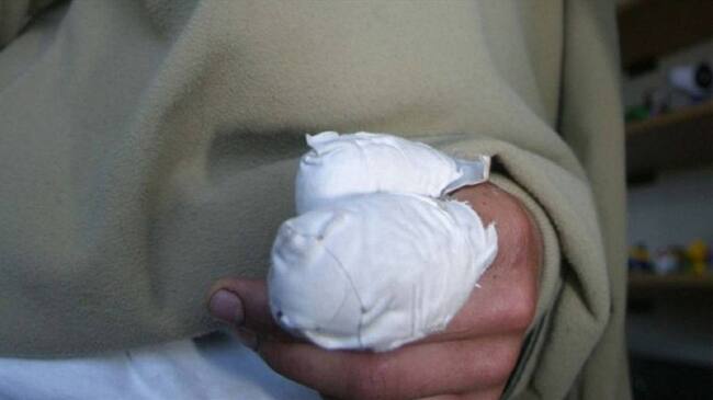 Lesionados con pólvora. Foto: Colprensa