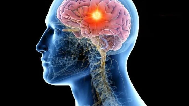 ¿Qué es muerte cerebral? Causas, señales de alerta y explicación, según neurólogo