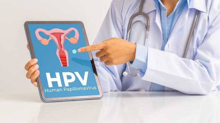 ¿El virus de papiloma humano es igual que el cáncer de cuello uterino? Médico aclaró dudas