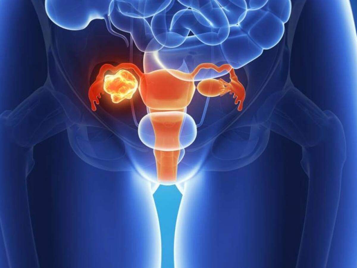 Cáncer de ovario: síntomas, factores de riesgo y tratamiento para uno de los más comunes en mujeres