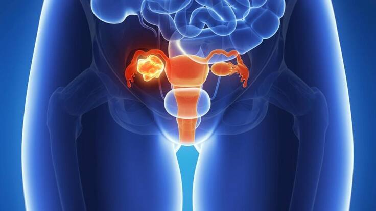 Cáncer de ovario: síntomas, factores de riesgo y tratamiento para uno de los más comunes en mujeres