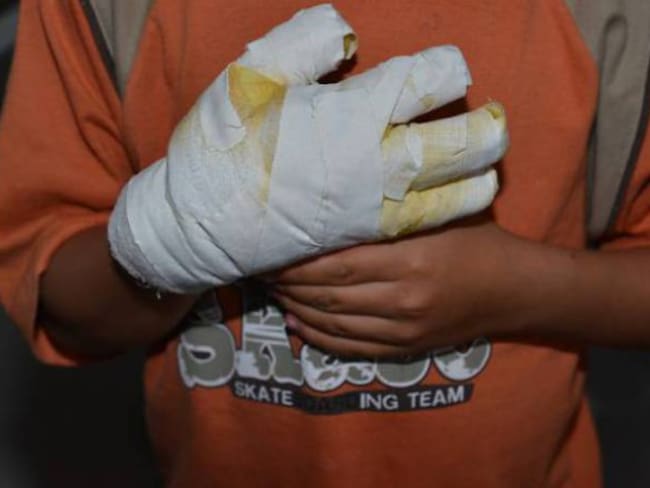 En Boyacá van a ala fecha 17 personas quemadas con pólvora, de los cuales seis son menores de edad / Foto. Cortesía