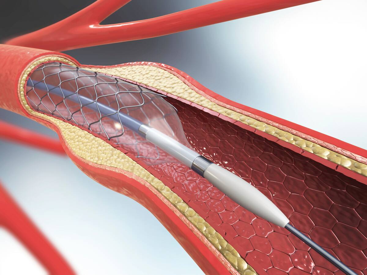 ABC del cateterismo explicado por cardiólogo: ¿de qué trata?