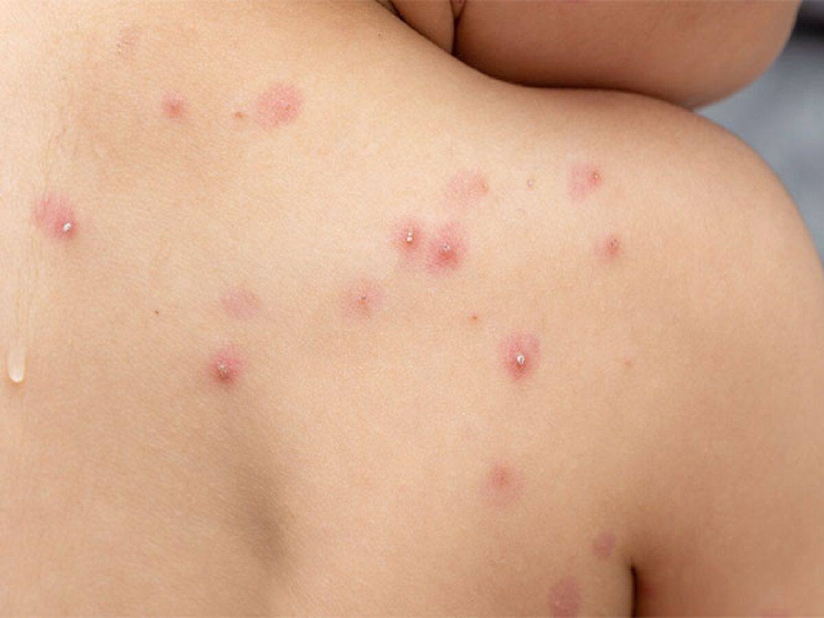 En alerta autoridades en Cúcuta por caso sospecho de viruela del mono