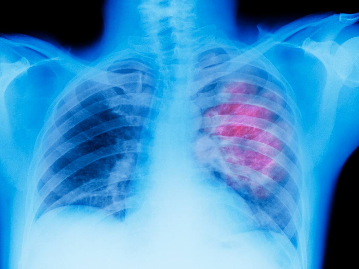 Estos son los factores de riesgo que aumentan la posibilidad de tener cáncer de pulmón