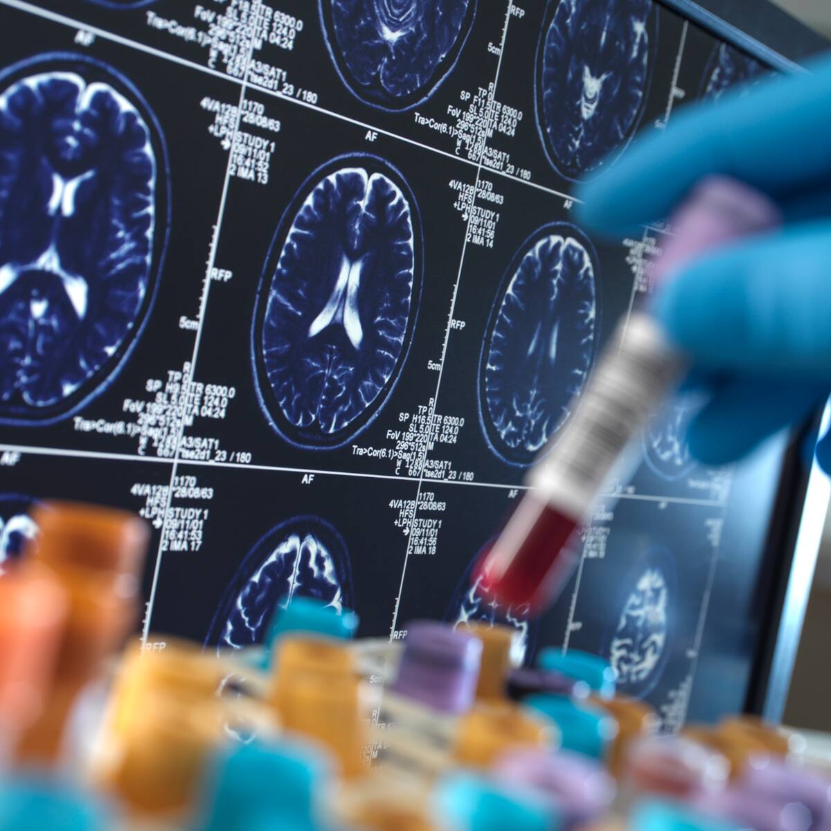 Hallazgo anticiparía diagnóstico de Alzhéimer décadas antes de primeros síntomas: ¿en qué consiste?