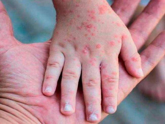  Confirman primer caso de la viruela del mono en Córdoba. Foto: GettyImages / Romolo Tavani