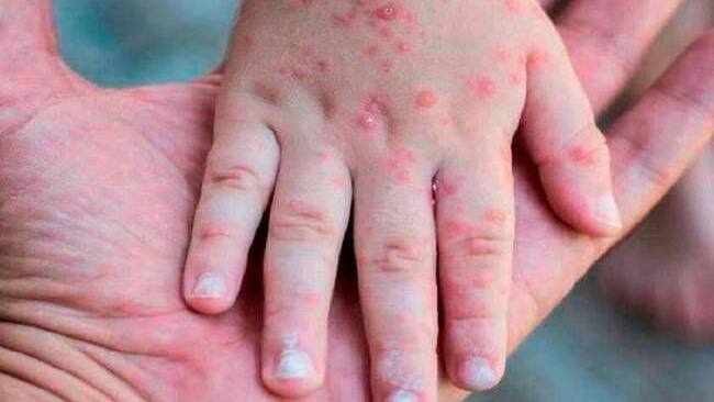 Confirman primer caso de la viruela del mono en Córdoba. Foto: GettyImages / Romolo Tavani