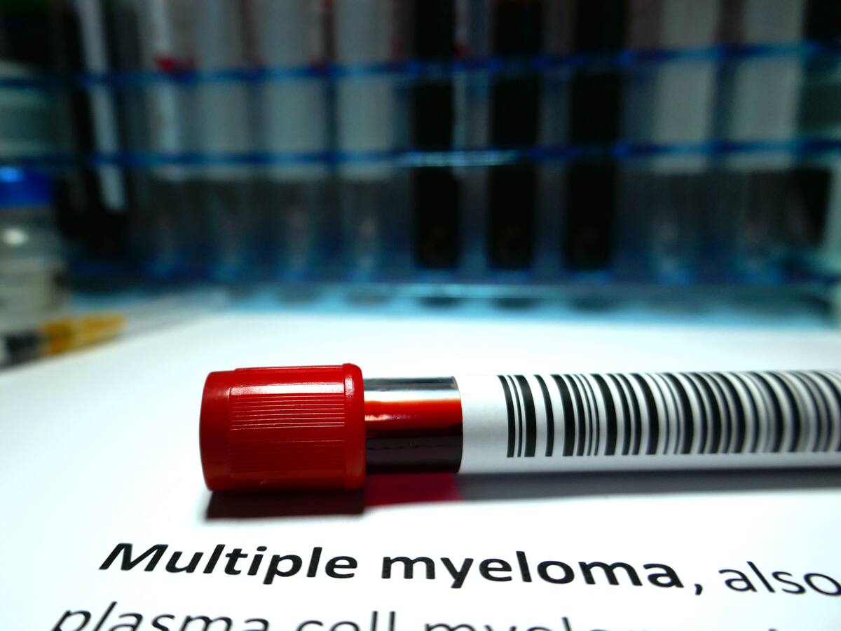 ¿Qué es el mieloma y qué lo causa?