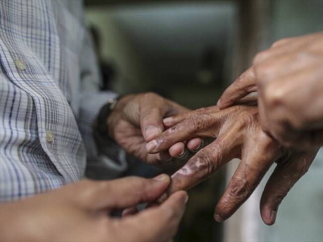 ¿La creía extinta? Esta es la realidad de la lepra en Colombia