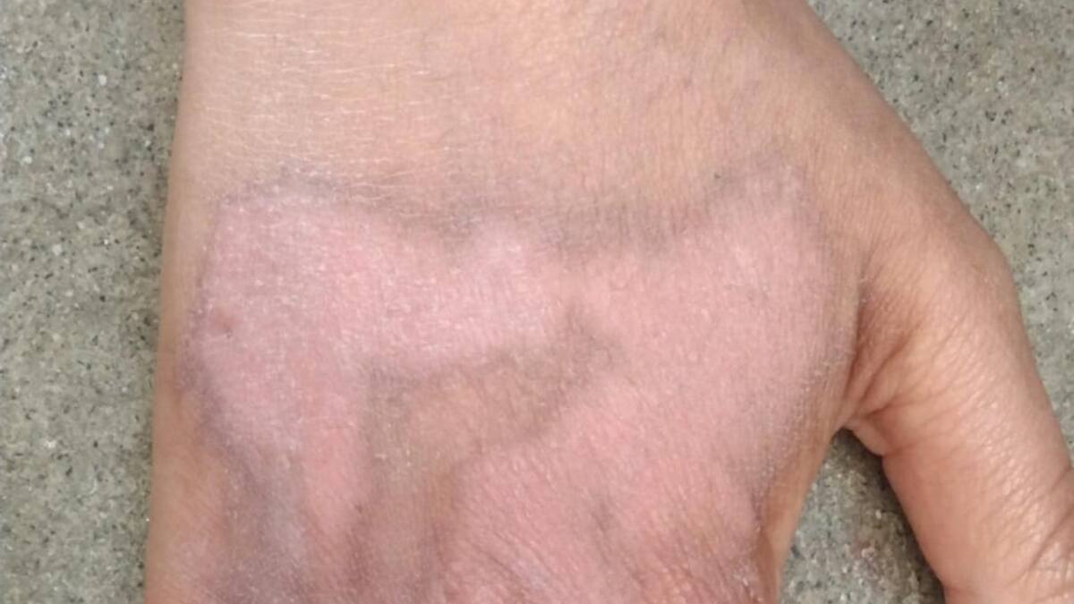 En Pereira activarán ruta de atención para casos de mujeres víctimas de ataques con ácido