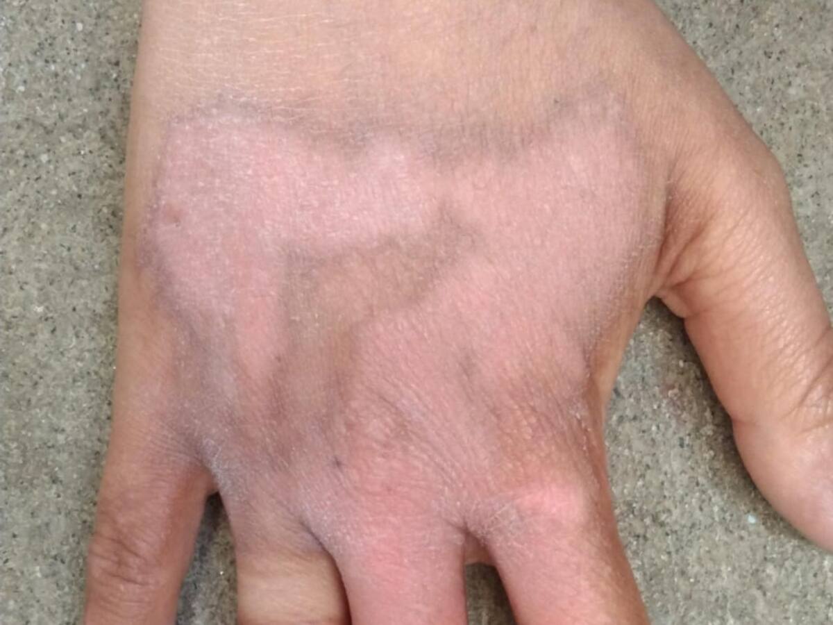 En Pereira activarán ruta de atención para casos de mujeres víctimas de ataques con ácido