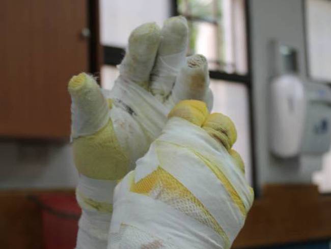 Quemados con pólvora. Foto: Cortesía Colprensa (referencia).