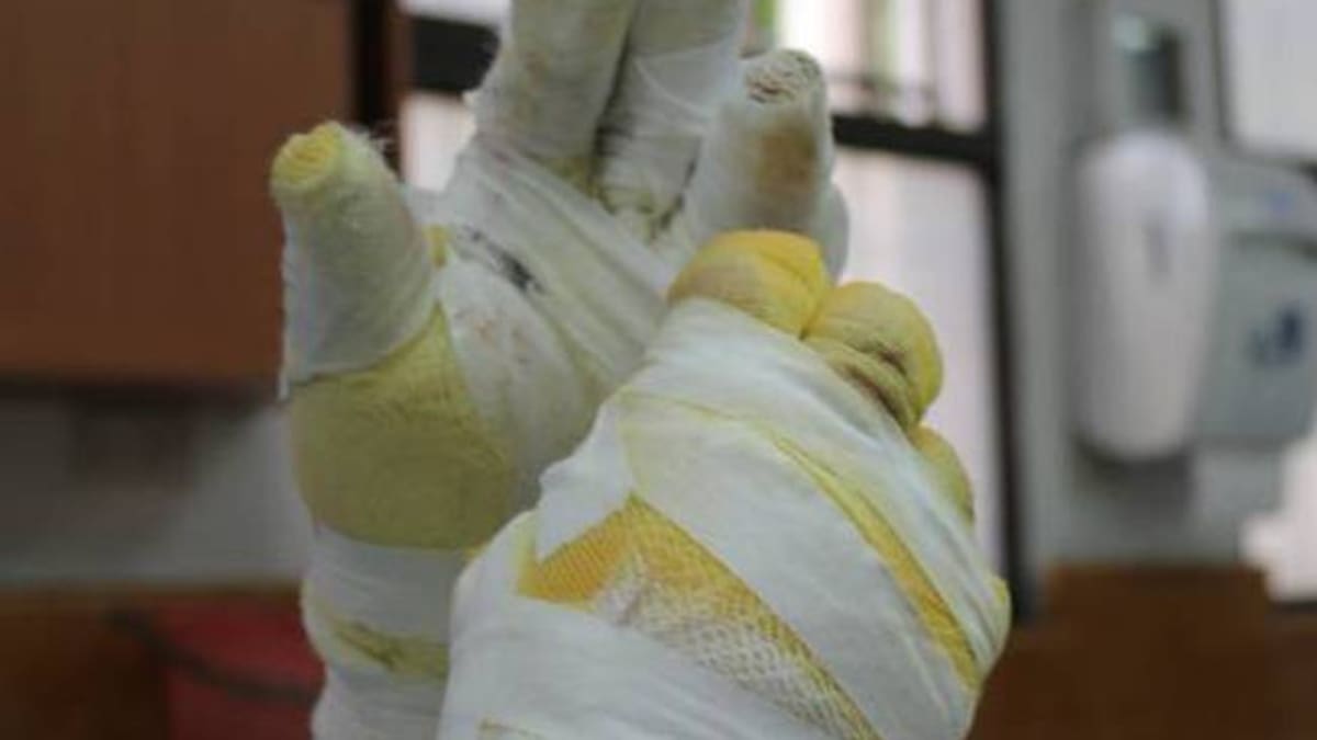 Córdoba y Sucre reportan más de 25 quemados por manipulación indebida de pólvora