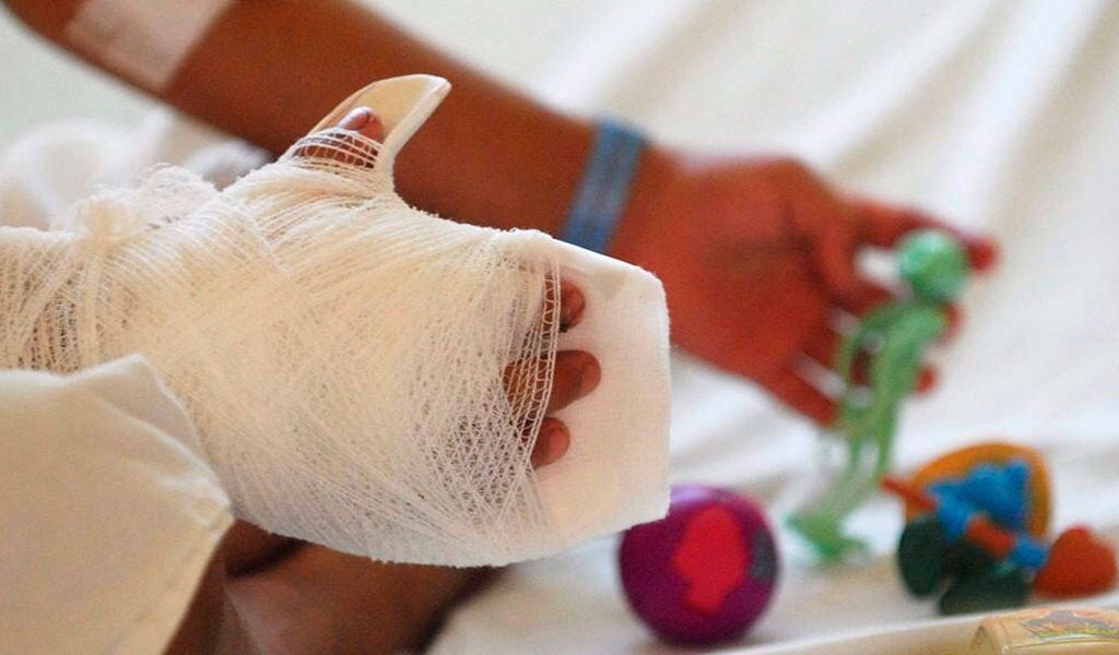 Imagen de referencia quemados con pólvora. Foto: Colprensa