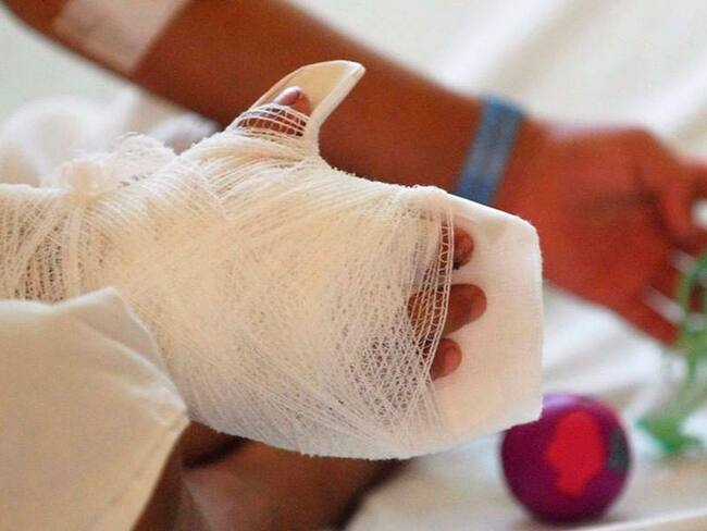 Imagen de referencia quemados con pólvora. Foto: Colprensa