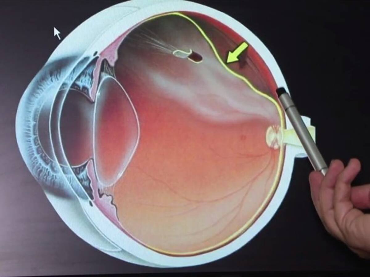 Desprendimiento de retina: causas y cómo tratar la urgencia