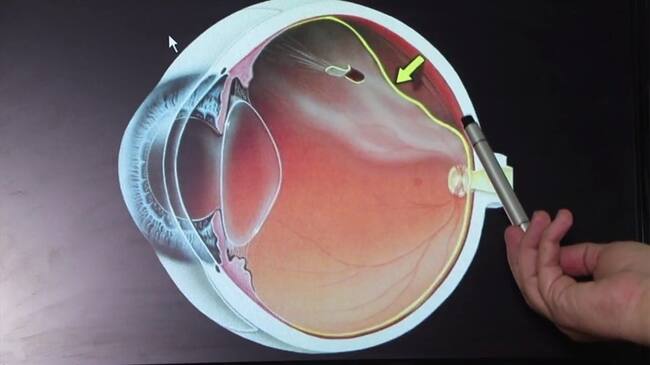 Desprendimiento de retina.
