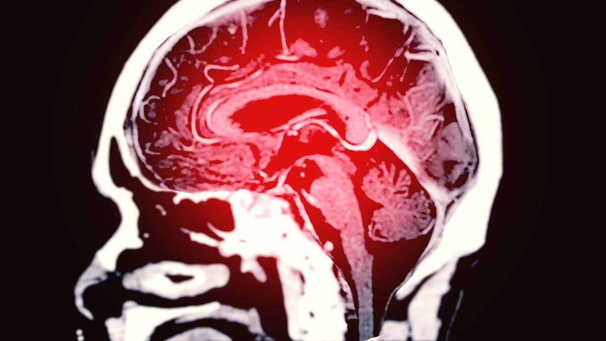 ¿Hay forma de saber si se es propenso a sufrir un ACV? Neurólogo explica