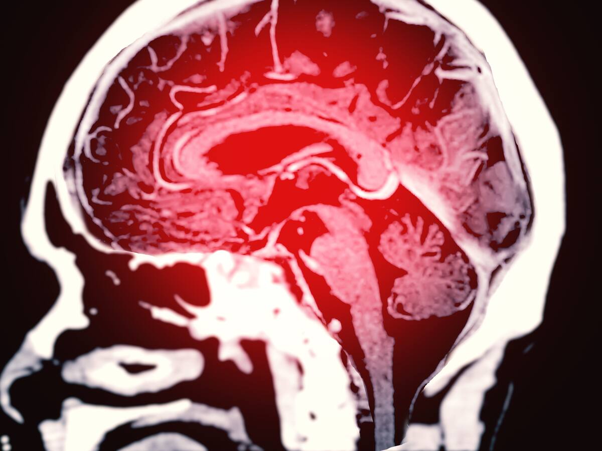 ¿Hay forma de saber si se es propenso a sufrir un ACV? Neurólogo explica