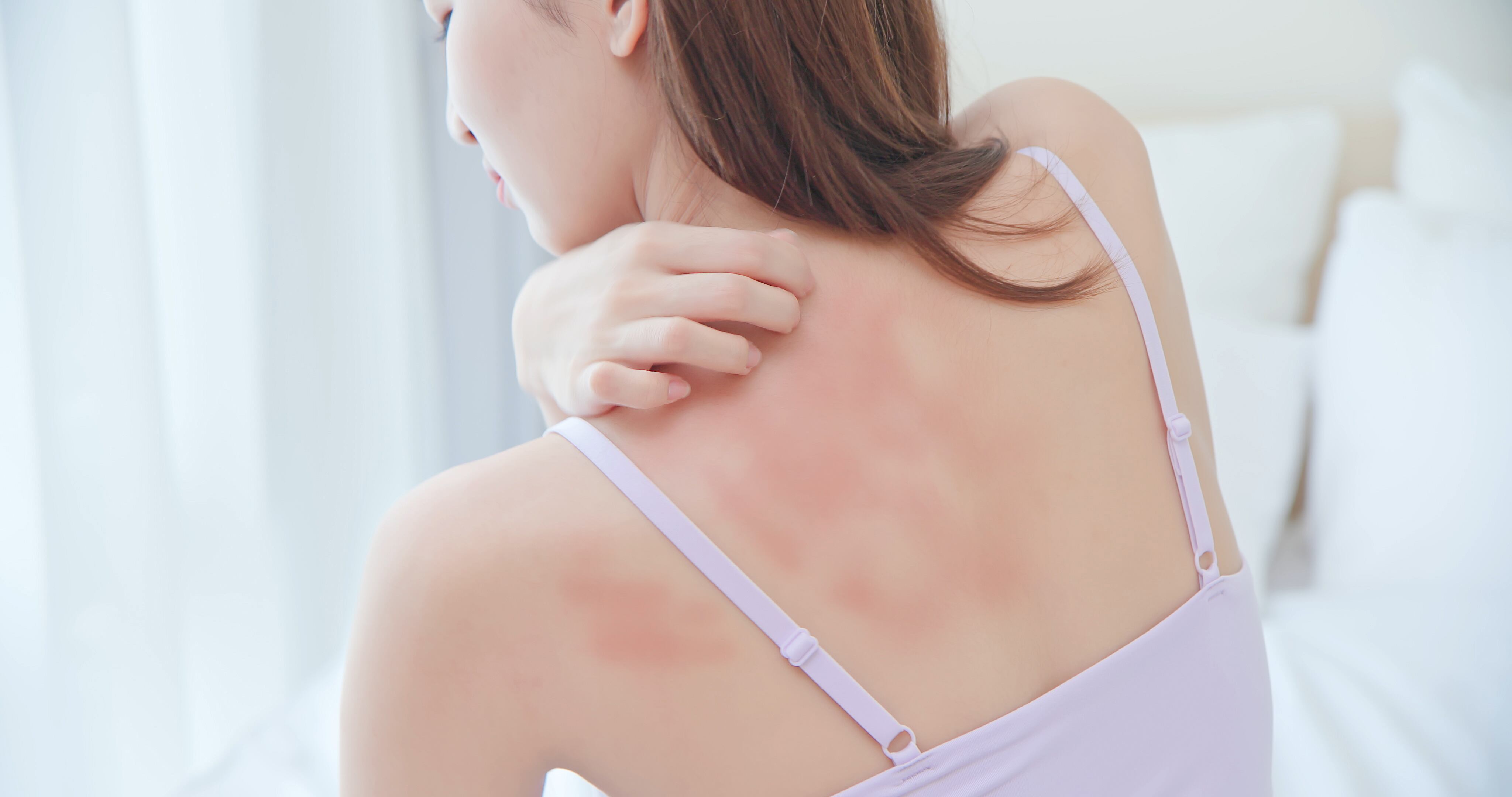 Imagen de referencia, dermatitis. Foto: Getty Images