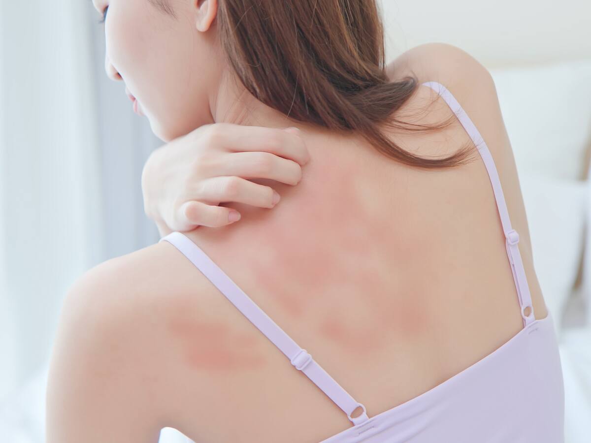 ¿Cómo tratar dermatitis atópica?: 6 consejos NO relacionados con aplicación de productos en la piel