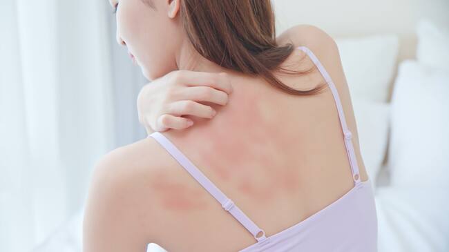 Imagen de referencia, dermatitis. Foto: Getty Images