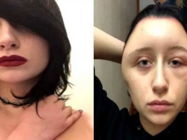 Al parecer la joven francesa no siguió las instrucciones del tinte y causó graves daños a su salud.. Foto: Cortesía