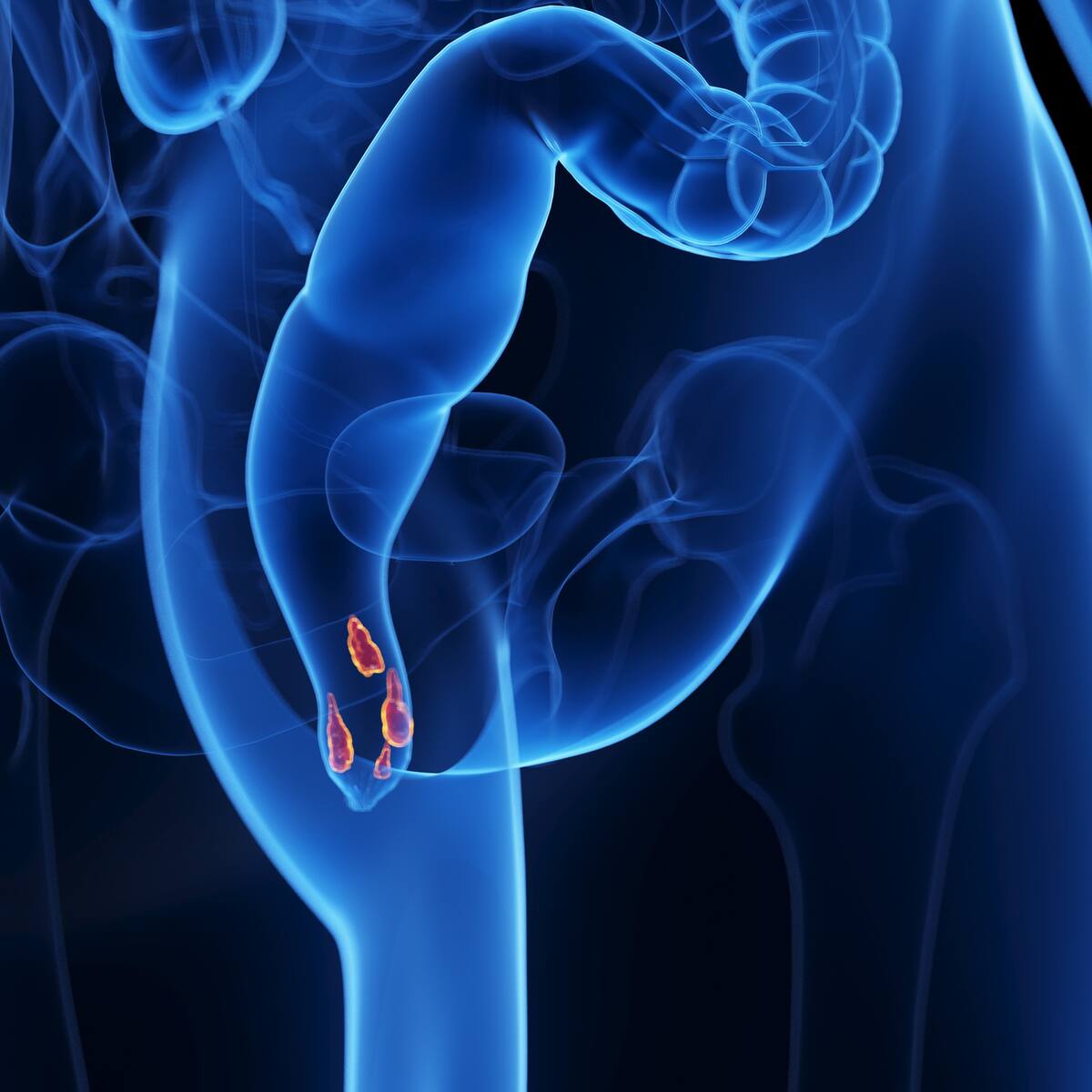 ¿Cómo saber que se está sufriendo de las hemorroides? Doctor explicó síntomas y causas