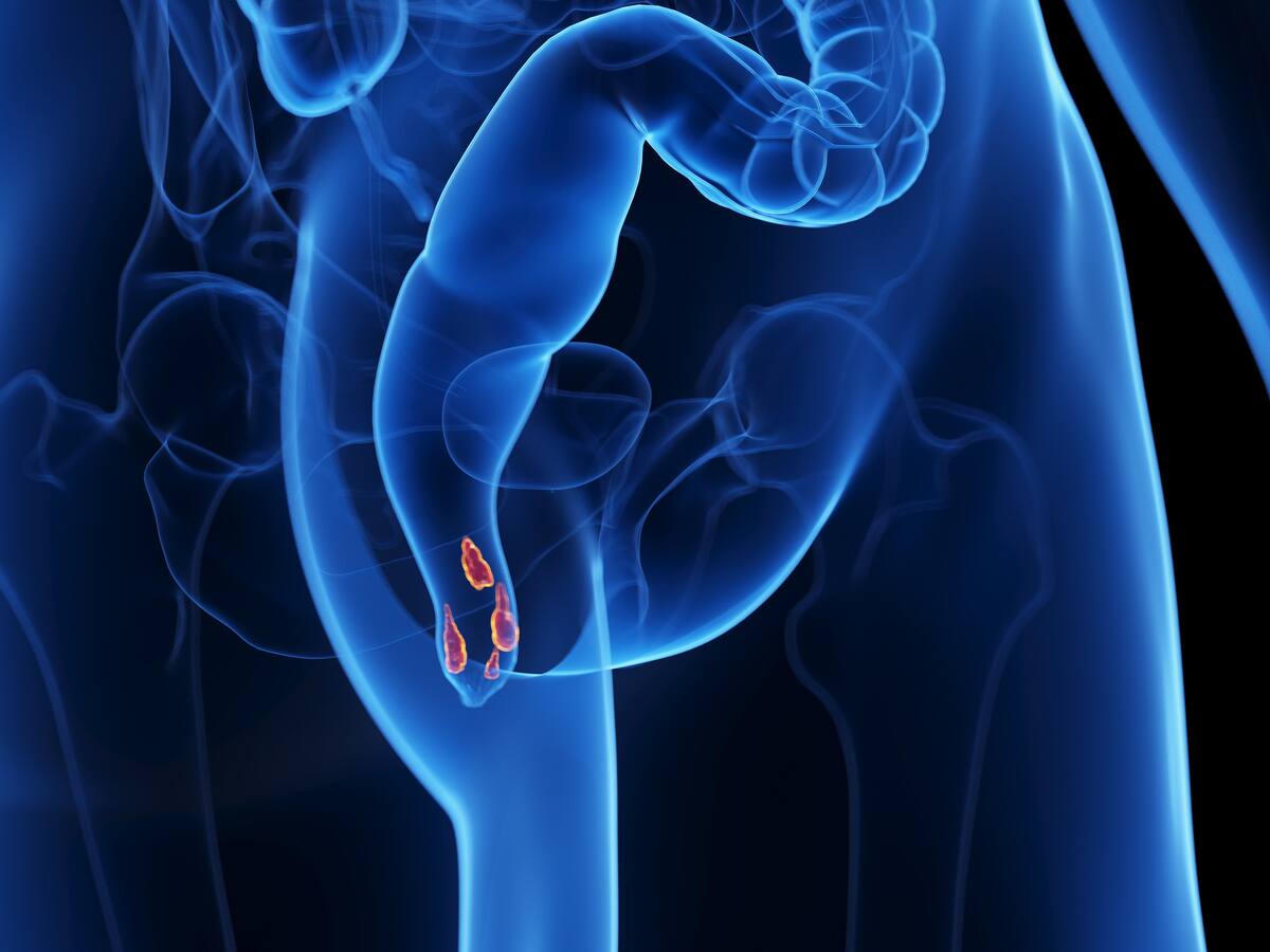 ¿Cómo saber que se está sufriendo de las hemorroides? Doctor explicó síntomas y causas