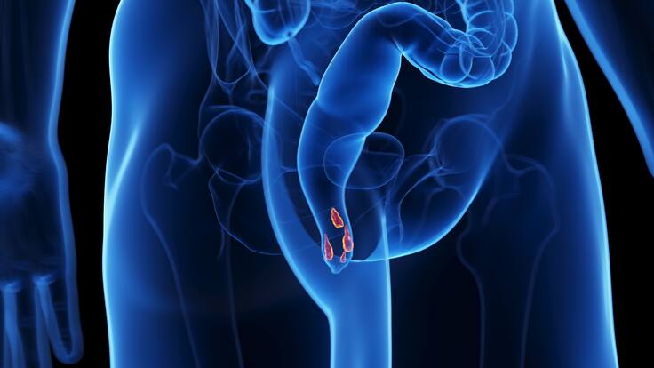 ¿Cómo saber que se está sufriendo de las hemorroides? Doctor explicó síntomas y causas