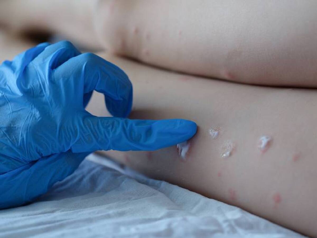 La OMS investiga si rapidez de propagación de viruela del mono se debe a mutaciones