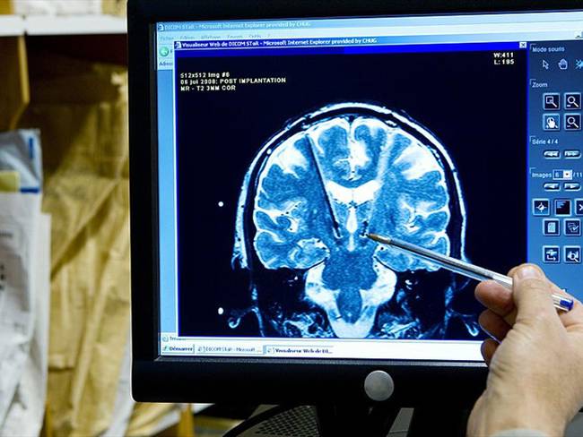 Los implantes cerebrales podrían ayudar a que personas con parálisis puedan hacer algunos movimientos. Foto: Getty Images